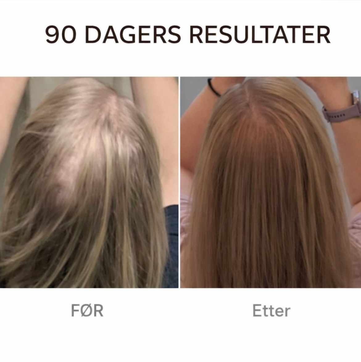 Rødt Lys Hårbørste - Få raskere hårvekst med bare 10 minutter om dagen